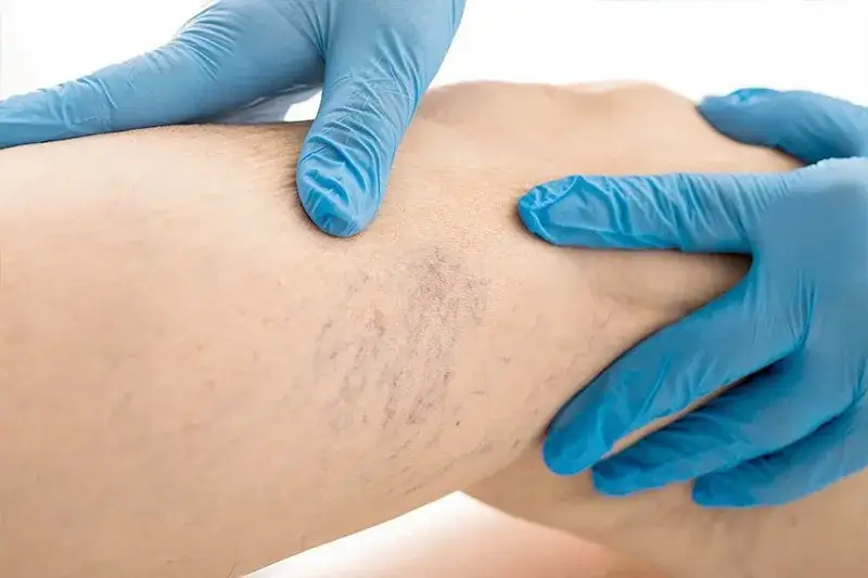 Czy po skleroterapii można pić alkohol: Poznaj zalecenia specjalistów