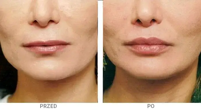Ile trzyma kwas hialuronowy w ustach? Poznaj sekrety trwałości efektów