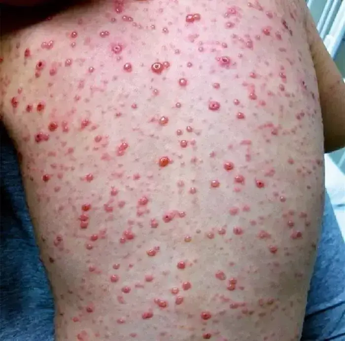 Kiedy powstała szczepionka na ospę i jak zmieniła świat zdrowia