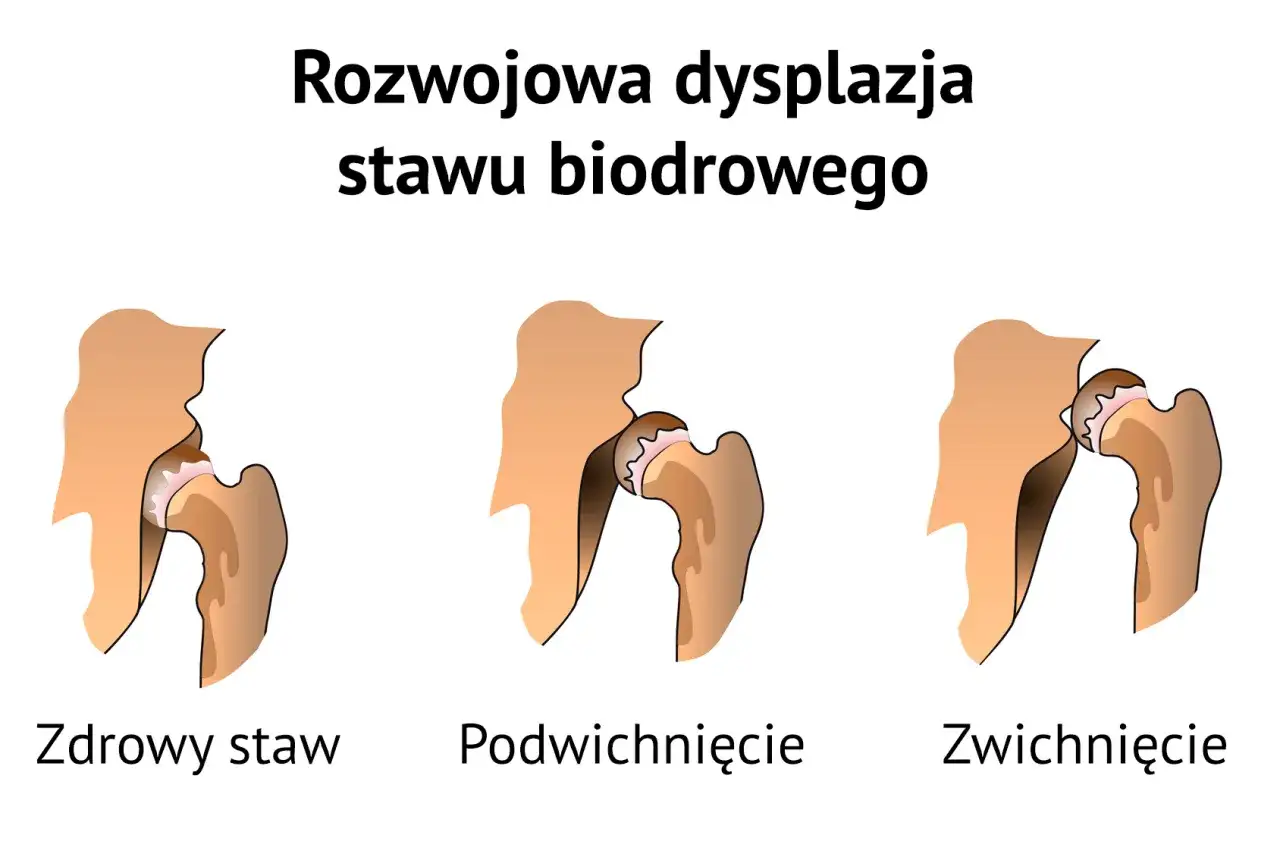 Poduszka Frejki: Jak długo? Decyzja ortopedy i Twoja rola
