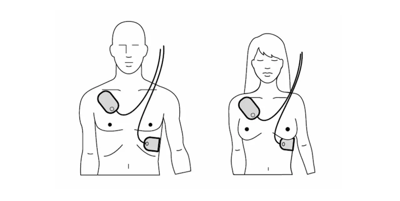 Defibrylator: resetuje serce, nie uruchamia? Prawda o NZK
