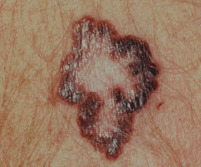 Co oznacza, gdy pieprzyk boli jak pryszcz? Sprawdź objawy i przyczyny