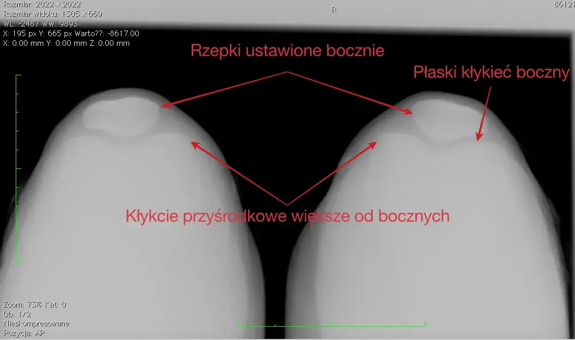 Zwichnięcie rzepki: ile trwa rehabilitacja? Od 4 tyg. do roku