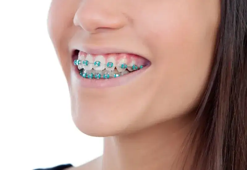 Aparat na zęby: Ile czasu nosić i jak długo trwa wizyta?