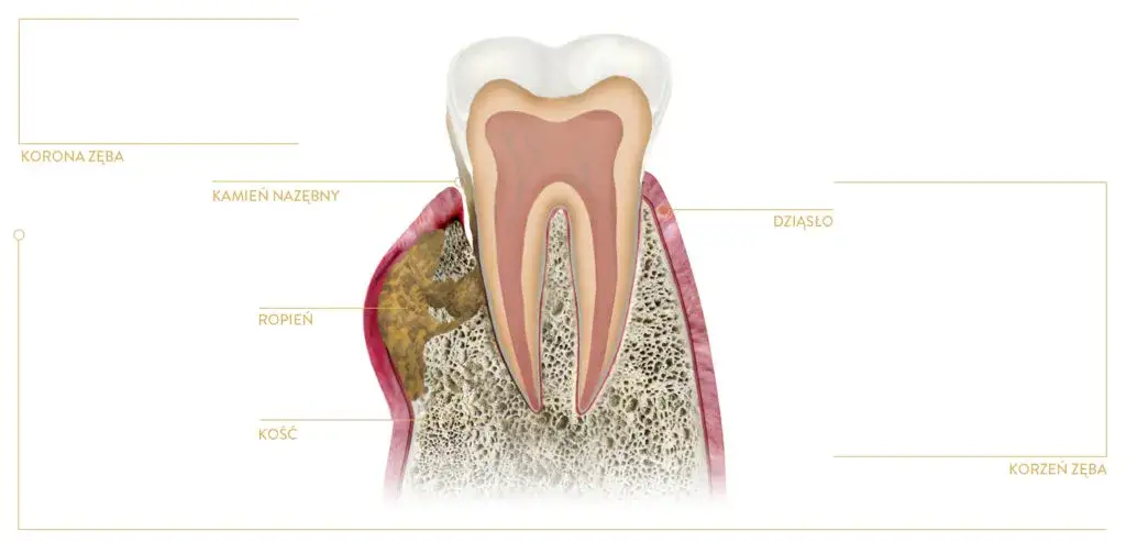 Ropa w dziąśle: Nie ignoruj! Objawy, leczenie, powikłania