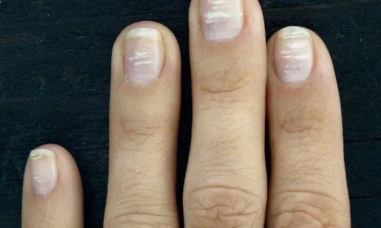 Co oznaczają białe plamy na paznokciach i jak je leczyć?