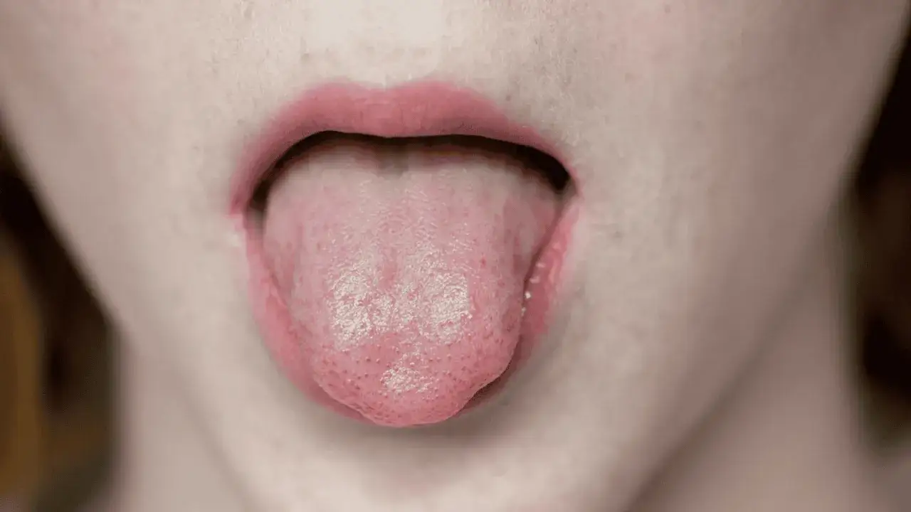 Usta z wyciągniętym językiem, na którym widać drobne nierówności, jakby mały bąbel pod językiem.