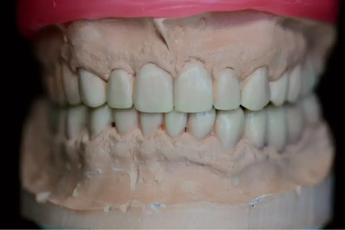 Model szczęki z protezą zębową. Dowiedz się, gdzie zrobić protezę zębową na NFZ.