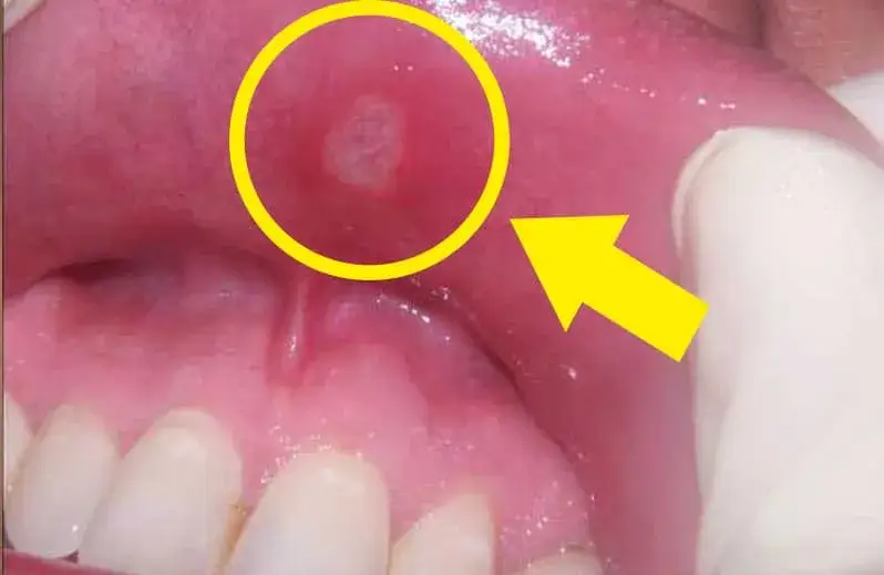 Zmiany w jamie ustnej: do jakiego lekarza się udać i kiedy to pilne?