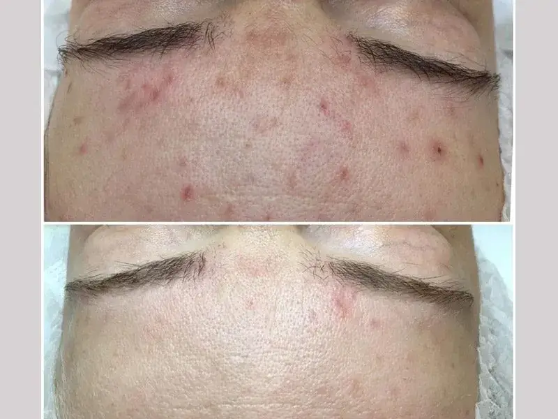 Blizny potrądzikowe: Kompleksowy przewodnik usuwania. Co działa?