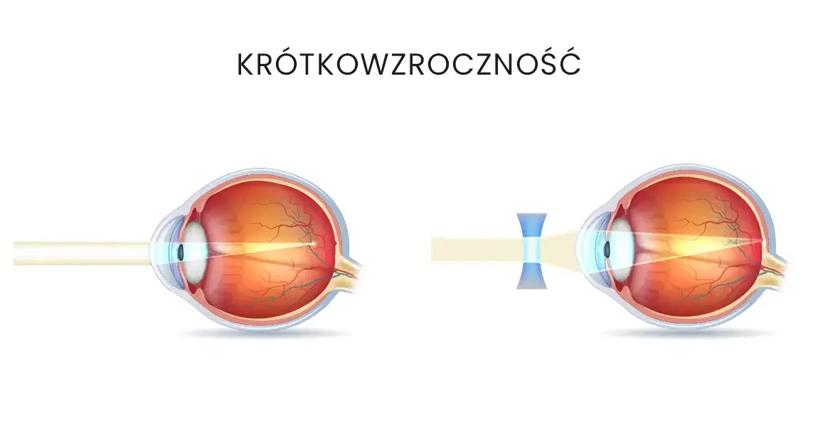 Krótkowzroczność: Jakie soczewki wybrać? Poradnik