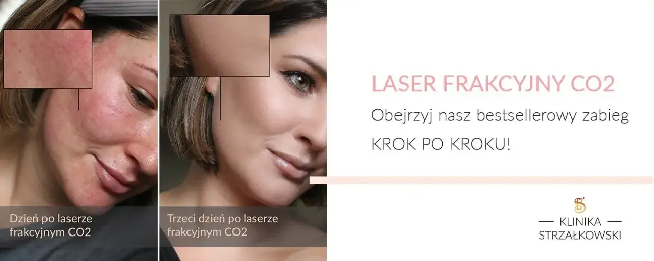 Laser frakcyjny: Jak szybko goić skórę? Poradnik krok po kroku