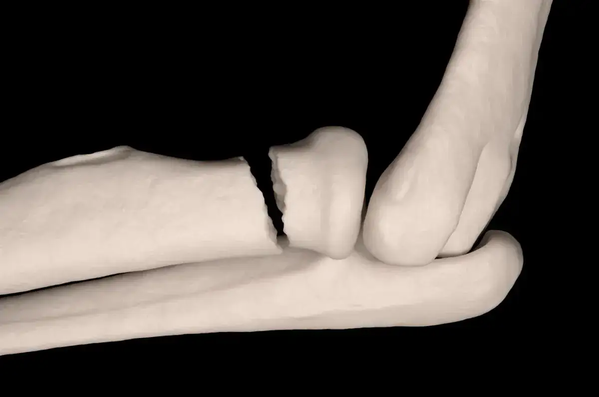 Złamanie kości promieniowej z przemieszczeniem: objawy i leczenie