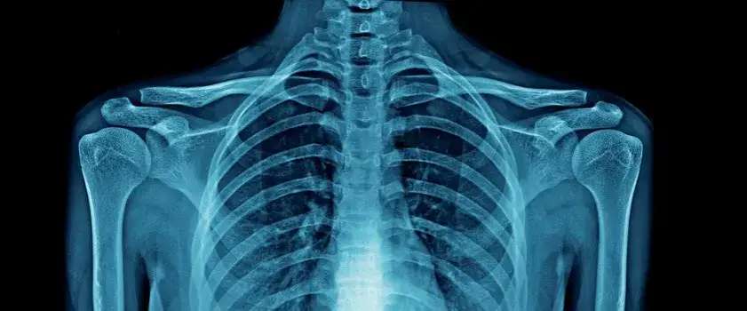 Skuteczne leczenie nadżerek kości: kompleksowa terapia i metody