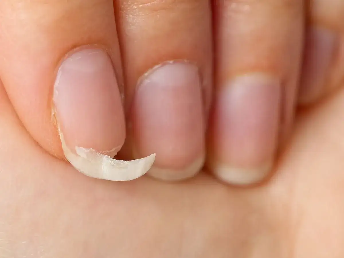 Zbliżenie na dłoń z widocznymi łamiącymi się paznokciami. Jeden paznokieć jest mocno uszkodzony, z odpryskującym fragmentem.