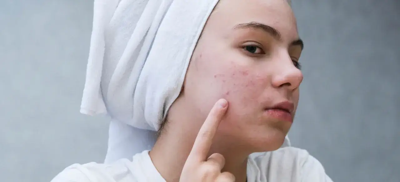 Dziewczyna z ręcznikiem na głowie wskazuje palcem na pryszcze na policzku.