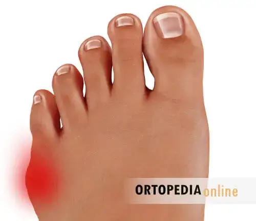 Bunionette (palec krawca): Jak leczyć haluksy małego palca? Pełen poradnik.