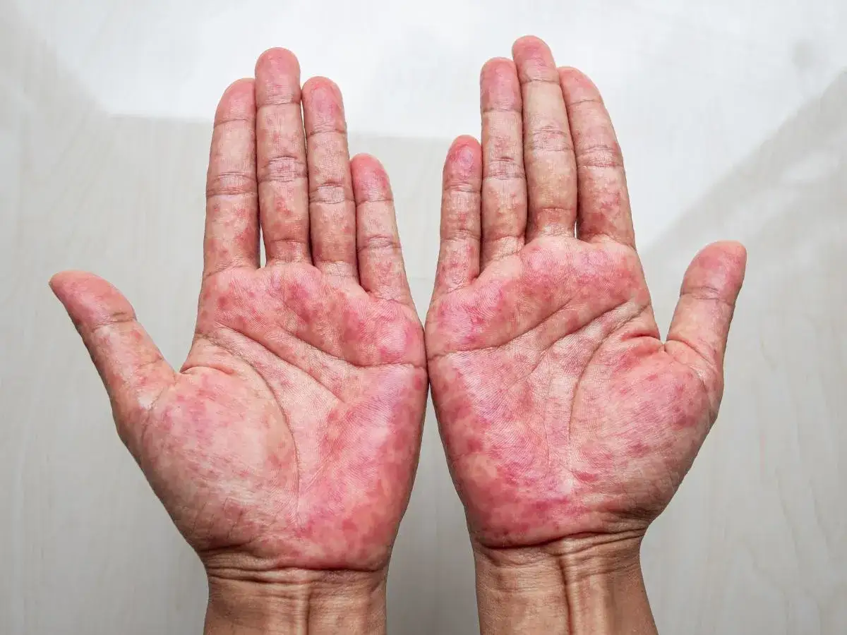 Dłonie z widocznymi zmianami skórnymi, zaczerwienieniem i drobnymi krostkami, wskazujące na choroby skóry dłoni.
