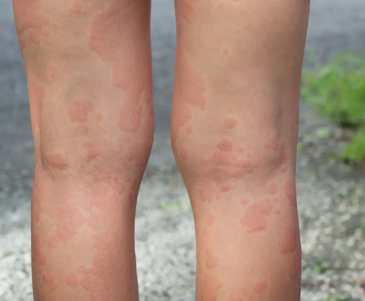 Alergia na słońce objawy: Zobacz, jak rozpoznać niebezpieczne reakcje