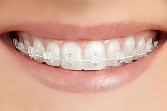 Aparat ortodontyczny: Zobacz, jak wyglądają różne typy!