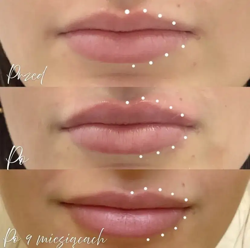 Najlepsze miejsca na zabiegi z kwasem hialuronowym w Warszawie