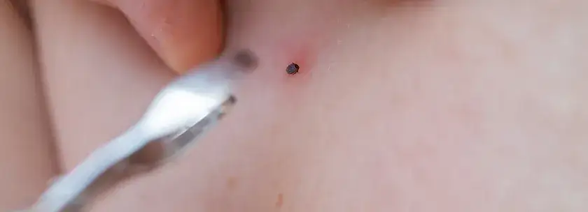 Czym smarować ugryzienie kleszcza? Unikaj tych niebezpiecznych substancji