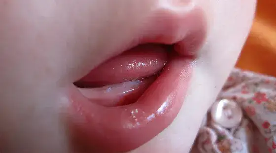 Jak wyglądają dziąsła niemowlaka przy ząbkowaniu - zdjęcia i objawy