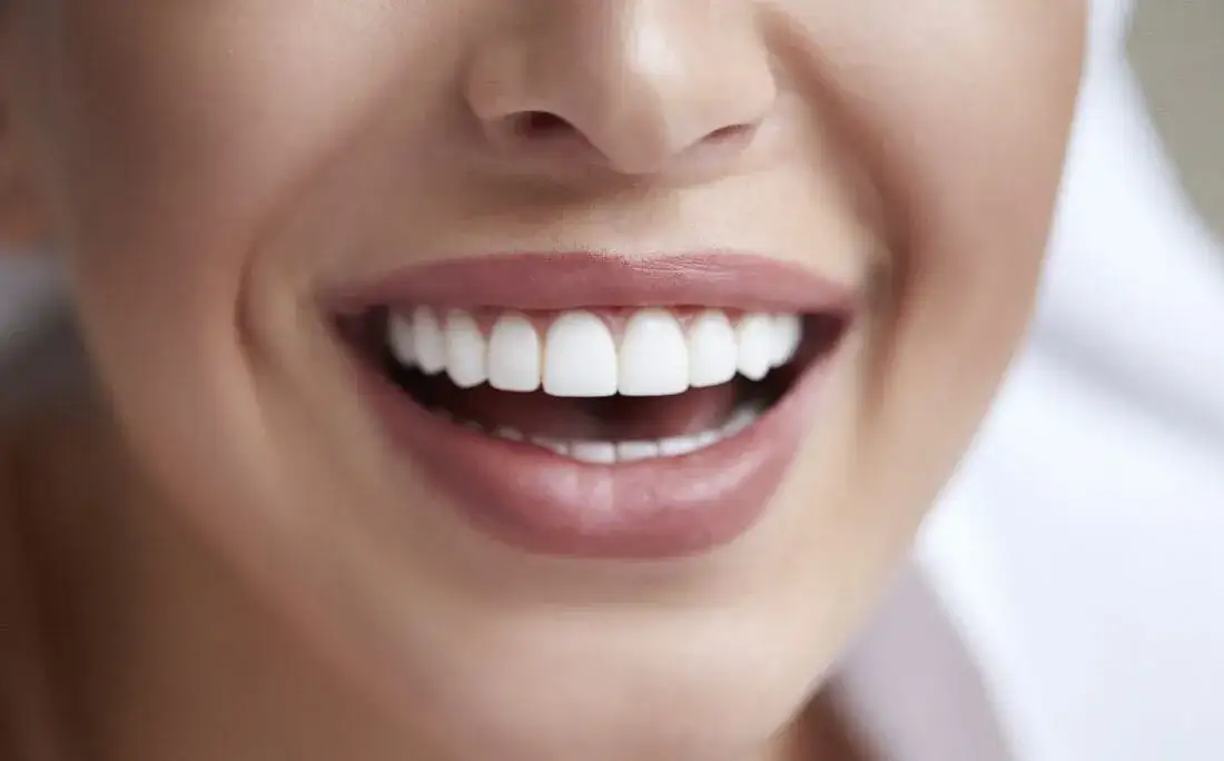 Ile licówek na zęby? Od 1 do 20 - poznaj swój idealny uśmiech