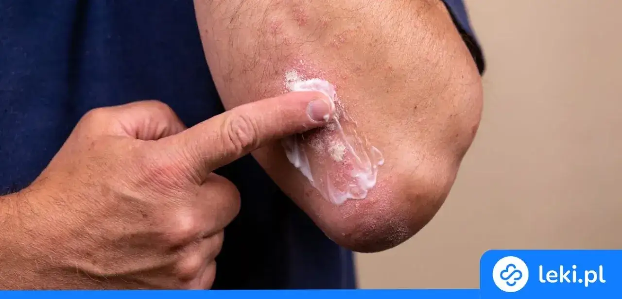 Jak szybko działają leki na alergię? Ulga w 5 minut czy dni?