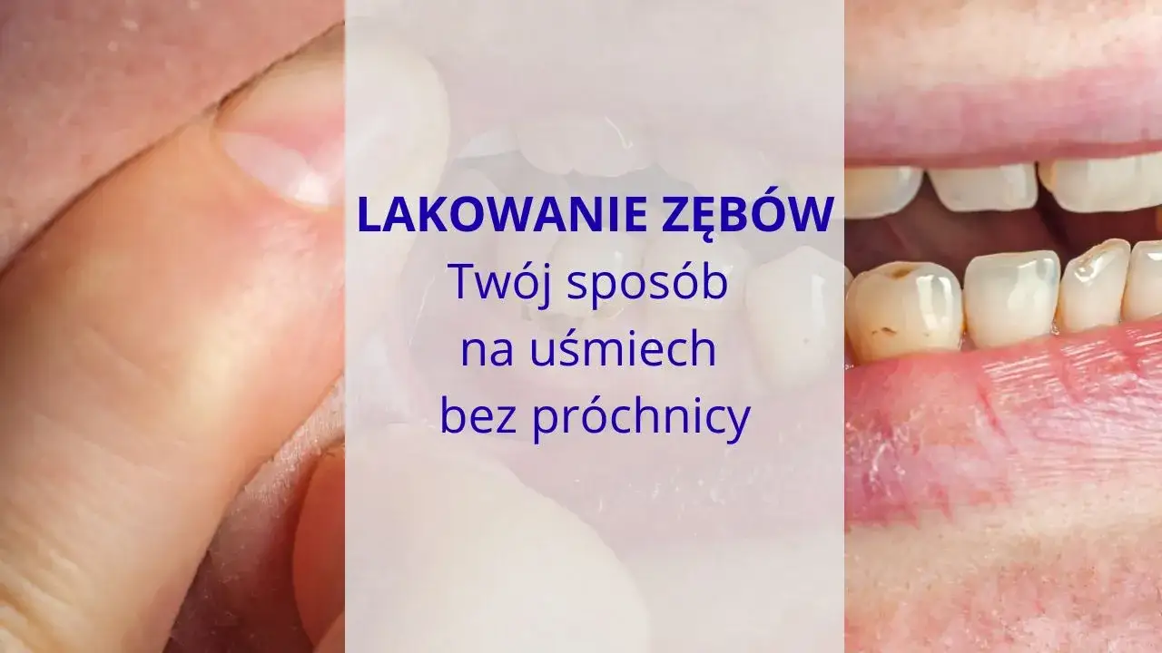 Jak skutecznie zapobiec próchnicy? Odkryj sekrety dentysty!