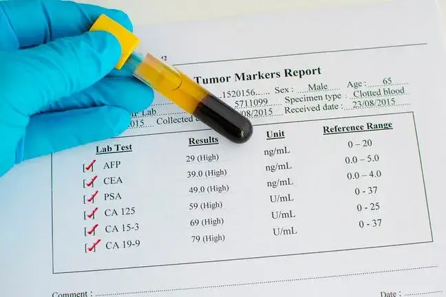 Badania krwi na raka jelita grubego: skuteczne markery i testy