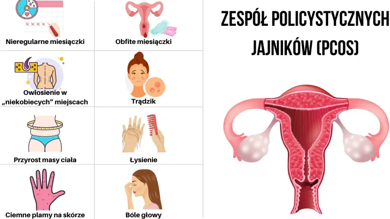 Zespół policystycznych jajników: Objawy, diagnoza i jak sobie z nim radzić