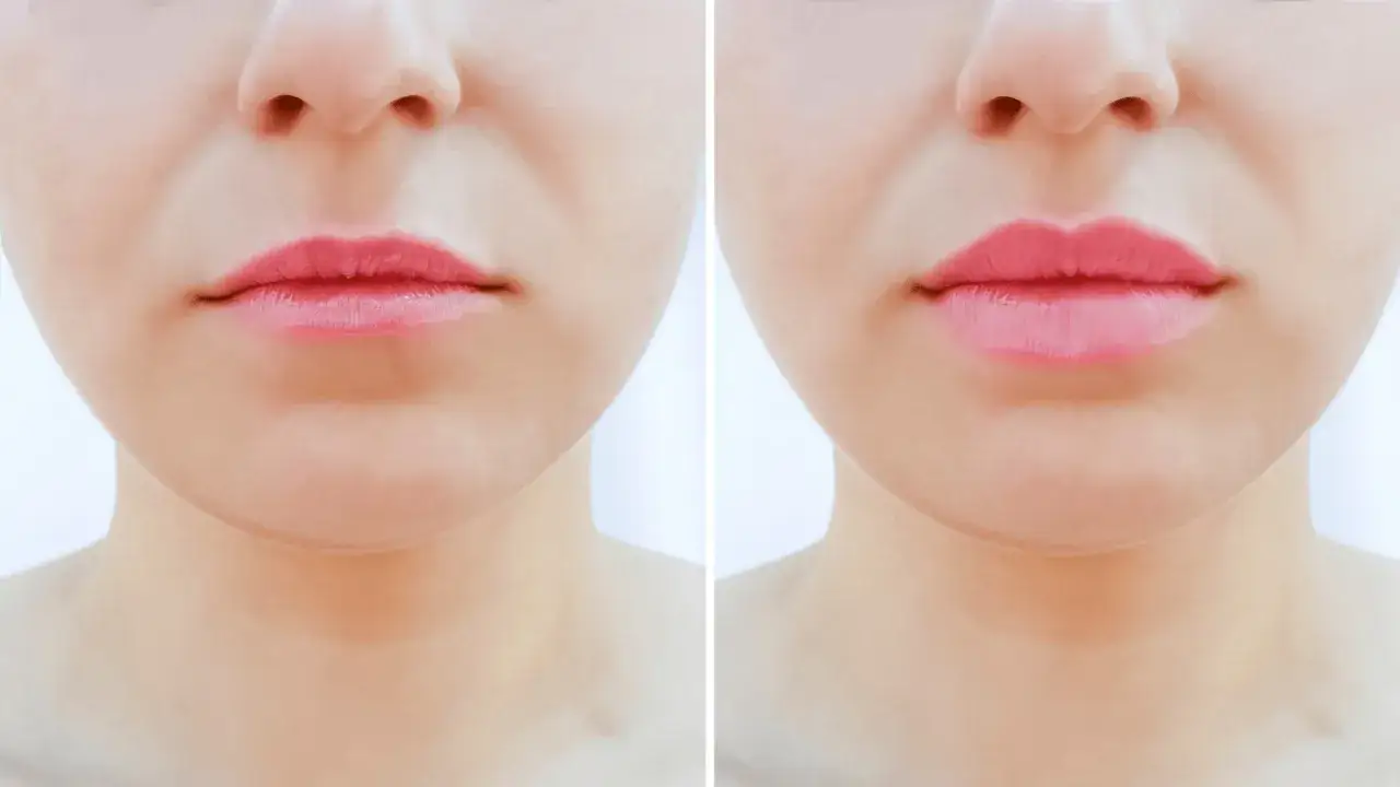 Ile kosztuje powiększanie ust botoksem w Warszawie? Ceny i porady