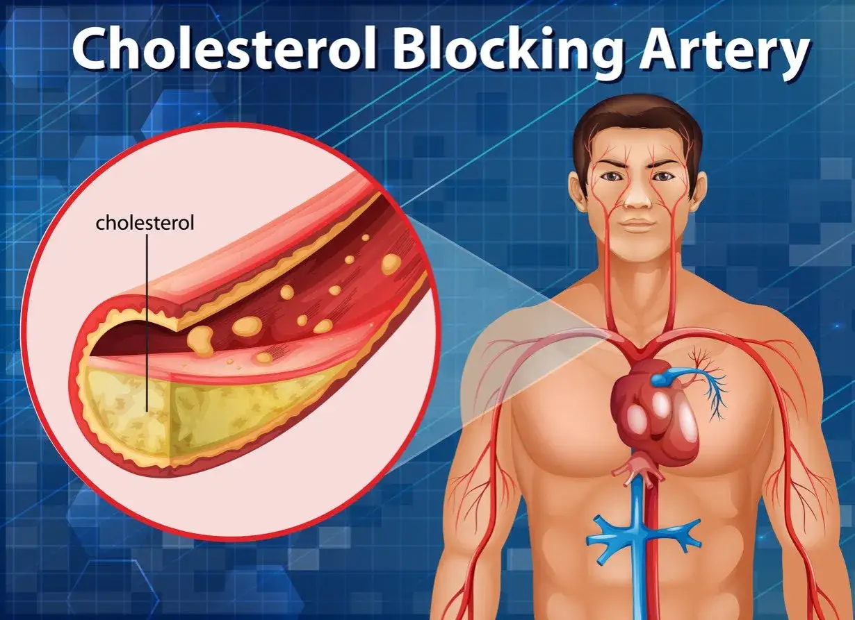 Miażdżyca: Do jakiego lekarza? Pełna ścieżka leczenia i objawy
