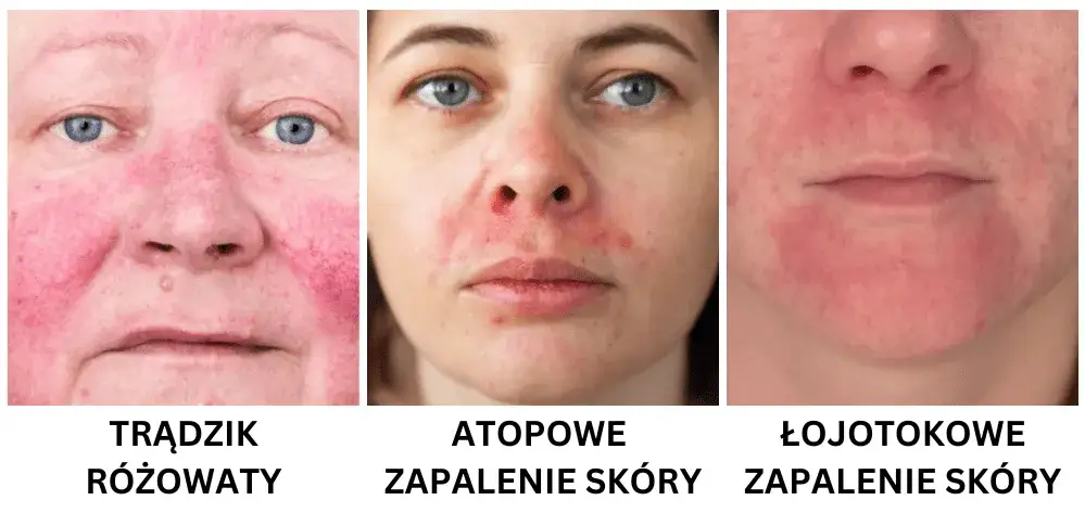 Jak rozpoznać cerę wrażliwą: objawy i skuteczne sposoby na pielęgnację