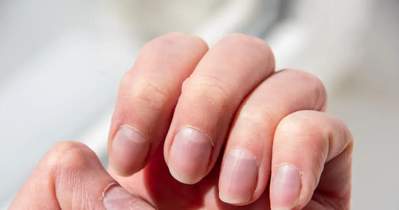 Niski poziom żelaza we krwi objawy – jak je rozpoznać i co zrobić