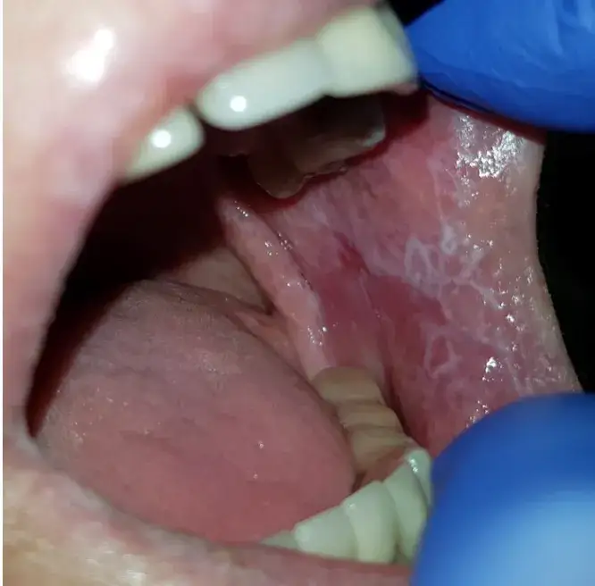 Liszaj płaski w jamie ustnej: Jak skutecznie leczyć i łagodzić ból?