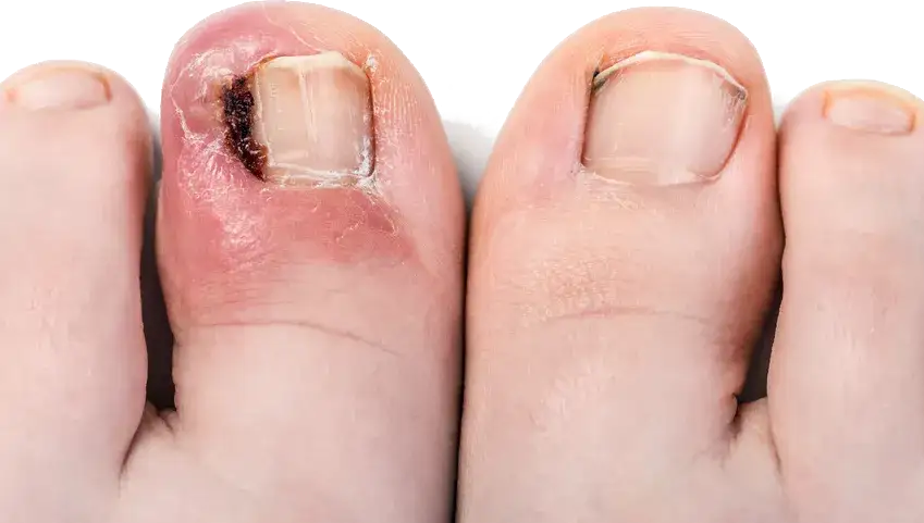 Tamponada paznokcia: jak długo nosić? Czas leczenia i efekty