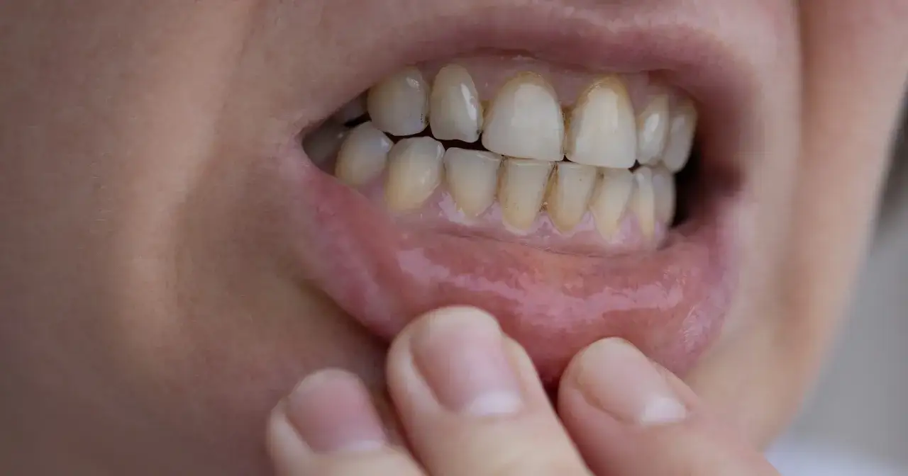 Czy usuwanie kamienia jest na NFZ? Sprawdź, co musisz wiedzieć