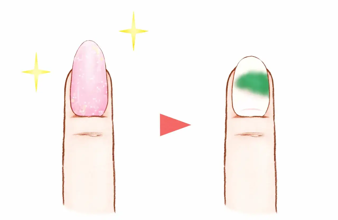 Piękny, różowy paznokieć z brokatem, a obok niego ten sam paznokieć z zieloną bakterią.