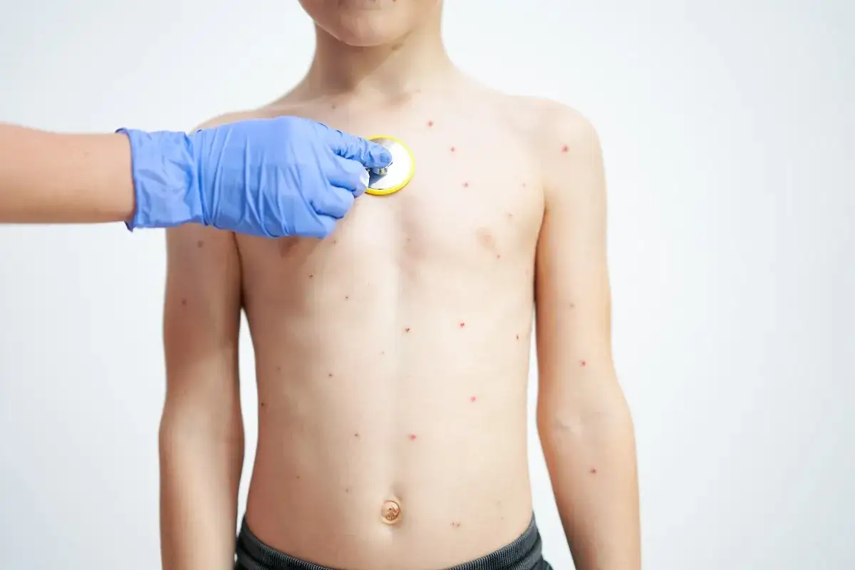 Jak zapobiec ospie po kontakcie? Szybkie kroki i profilaktyka