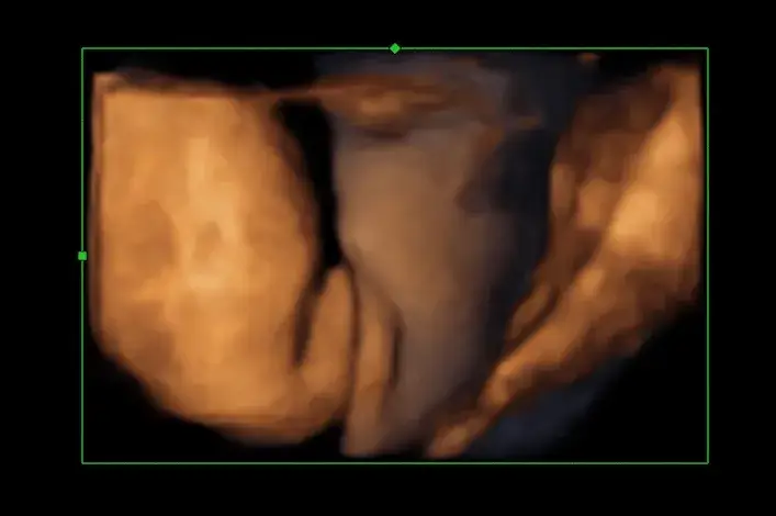 Jak rozpoznać płeć dziecka na usg - kluczowe informacje i porady