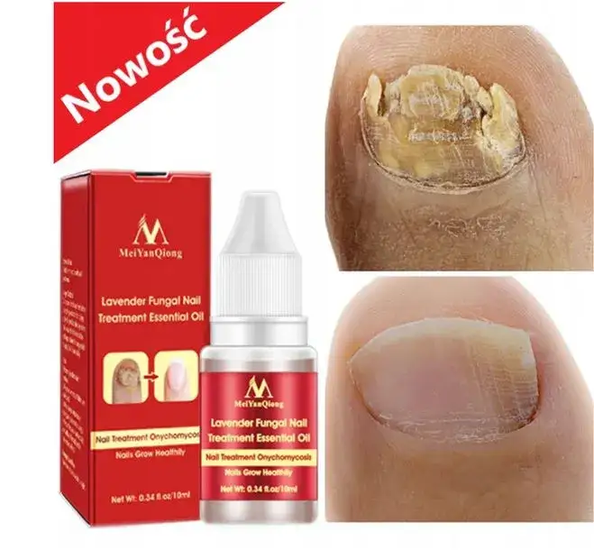 Najlepsze leki na grzybicę paznokci: skuteczne metody leczenia