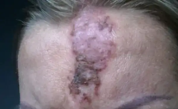 Martwica po kwasie hialuronowym objawy - jak je rozpoznać i uniknąć?