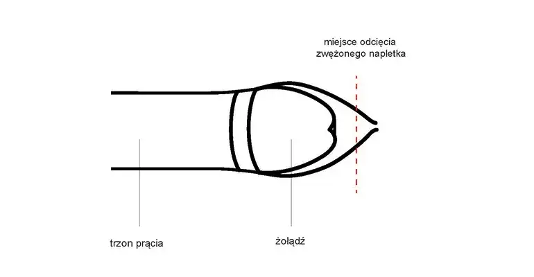 Jak ściągnąć skórę z napletka u dziecka bez bólu i komplikacji