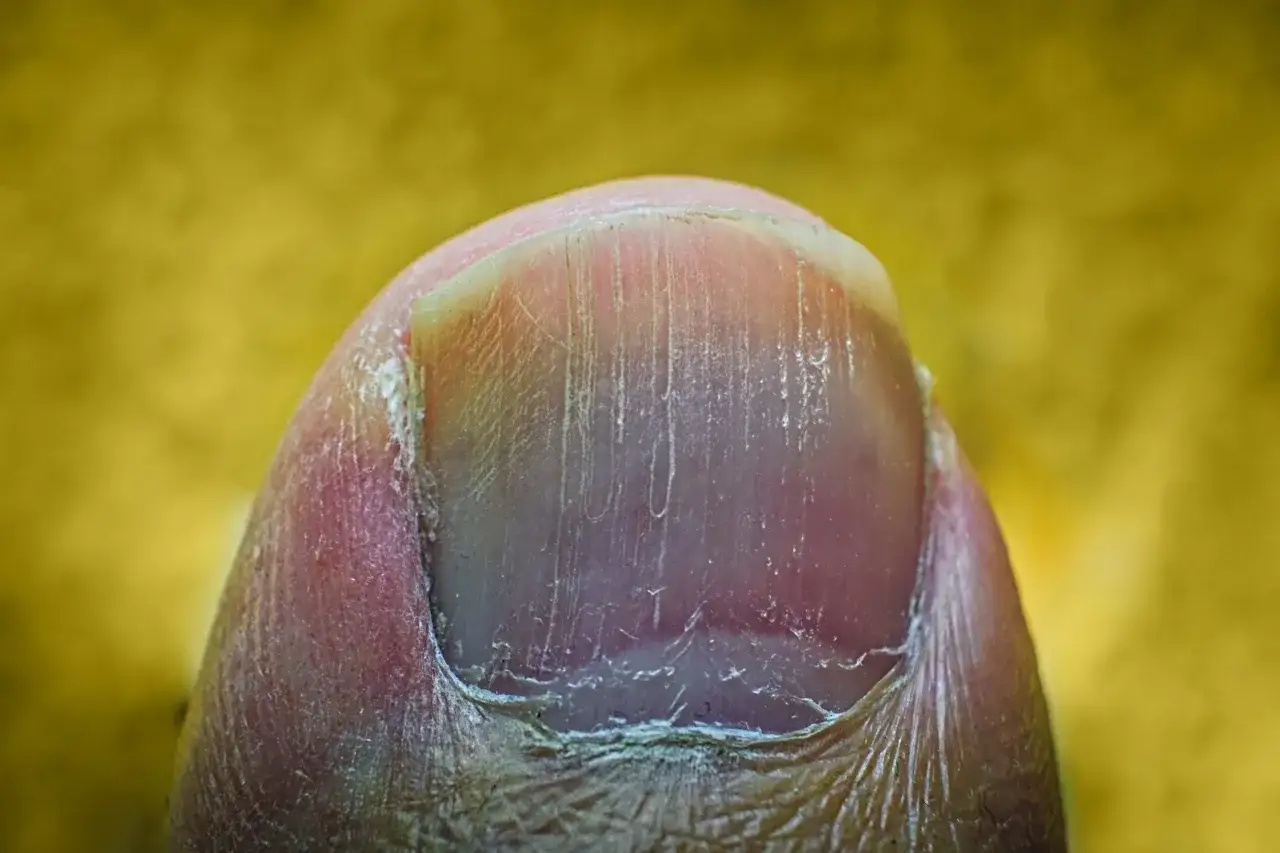 Jak skutecznie pozbyć się pionowych bruzd na paznokciach i poprawić ich wygląd