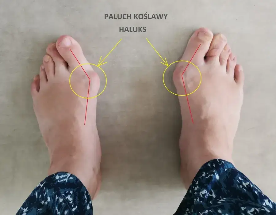 Do jakiego lekarza z haluksami? Ortopeda, podolog, fizjoterapeuta