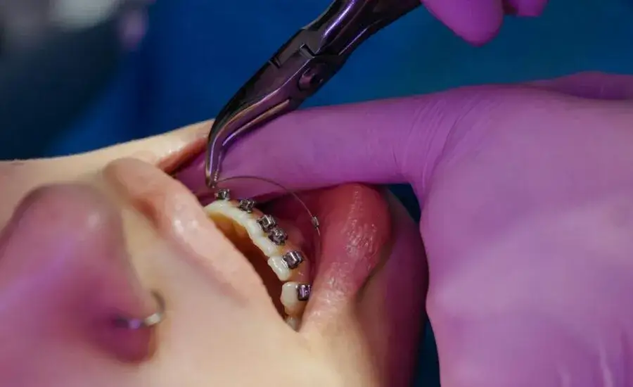 Aparat ortodontyczny: na jakie zęby i dlaczego warto? Pełny przewodnik