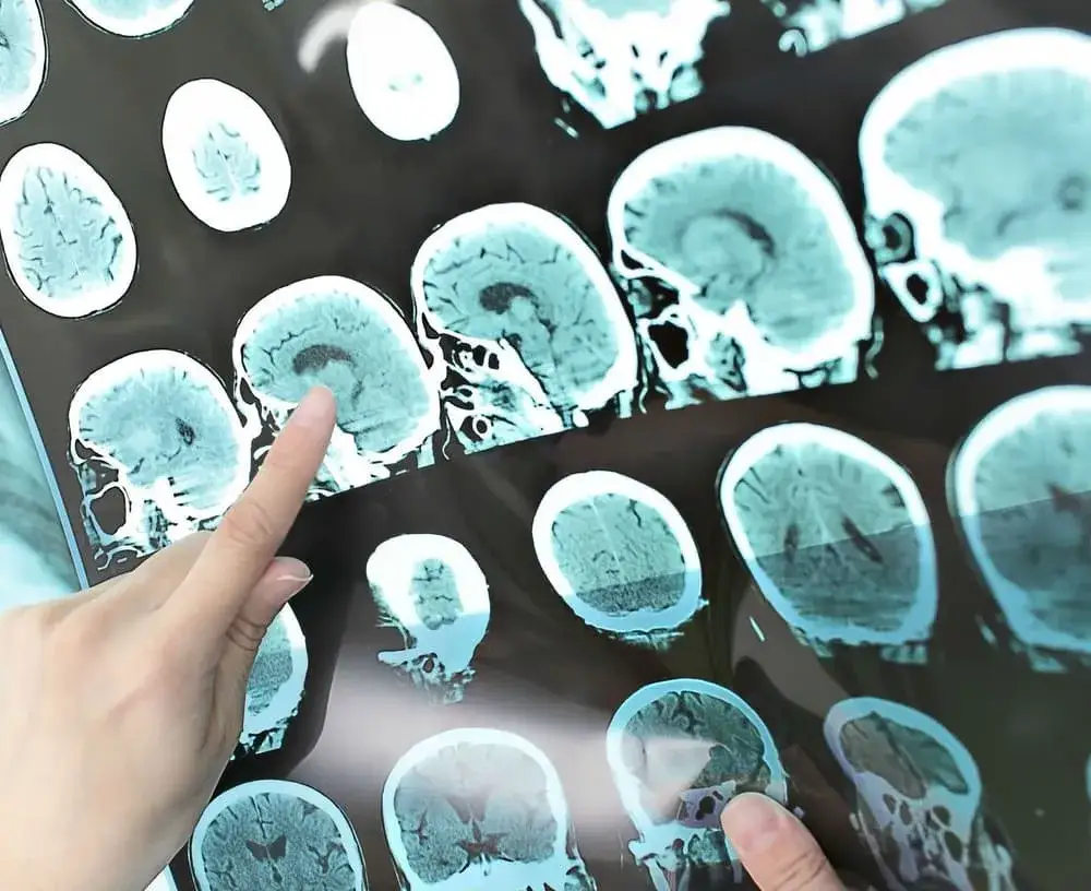 Guz mózgu czy nerwica: jak rozpoznać niebezpieczne objawy?