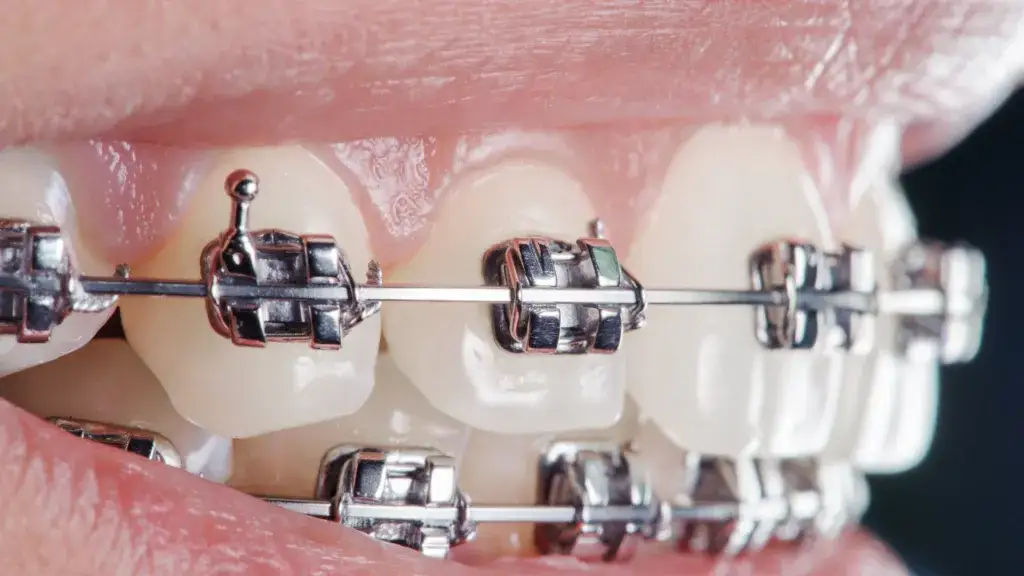 Jaki aparat na zęby wybrać? Koszty, typy, wady i zalety dla dorosłych.